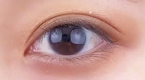 定點雙眼皮多少錢？雙眼皮定點好嗎？