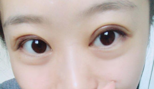 定點(diǎn)雙眼皮能維持幾年？