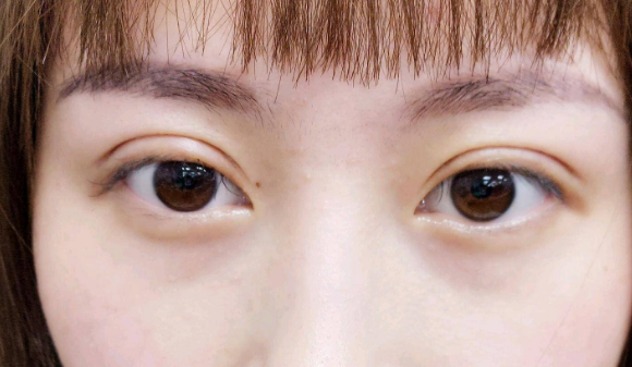定點雙眼皮是什么意思？雙眼皮定點能維持多久？