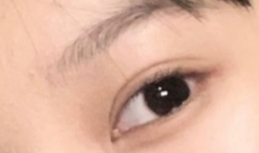 定點(diǎn)雙眼皮疼嗎？定點(diǎn)雙眼皮做完要多久時(shí)間？