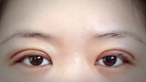 定點雙眼皮幾天能恢復好？