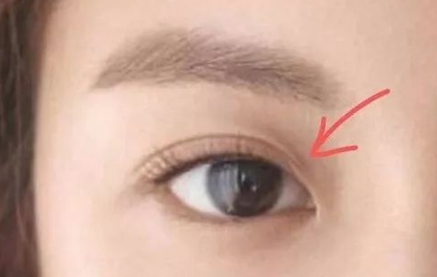 定點雙眼皮一般多少錢？