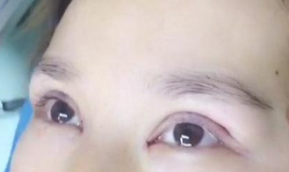 定點(diǎn)雙眼皮手術(shù)效果自然嗎？定點(diǎn)雙眼皮失敗怎么修復(fù)？