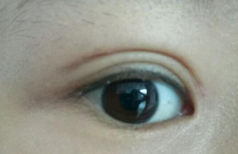 定點雙眼皮是怎么做的？