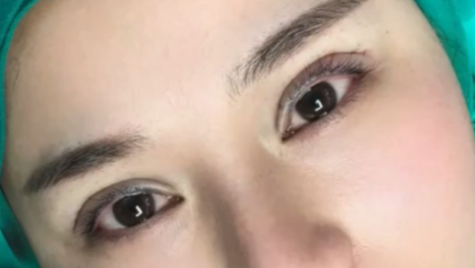 40歲做埋線雙眼皮的效果好不好？