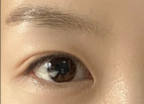 割雙眼皮后自然嗎？割雙眼皮后有危害嗎？