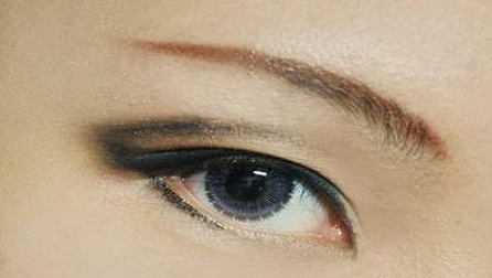 疤痕皮膚可以割雙眼皮嗎？40歲做埋線雙眼皮的效果好不好？