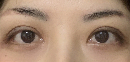 定點(diǎn)雙眼皮會(huì)腫嗎？