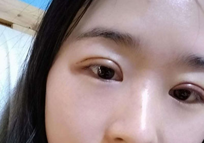 割雙眼皮后眼睛會變大嗎？