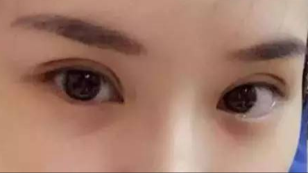 做雙眼皮對(duì)身體有沒(méi)有危害？