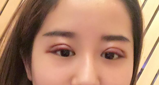 做雙眼皮大概多少錢？做雙眼皮拆線疼嗎？