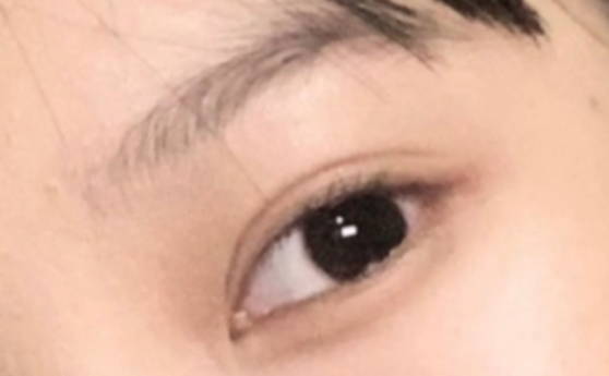 做雙眼皮效果能保持多久？做雙眼皮要冰敷多久？