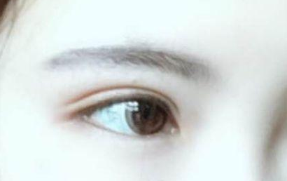 開(kāi)眼角的恢復(fù)期多長(zhǎng)？開(kāi)眼角的后遺癥都有什么？