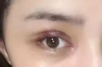 韓式開眼角失敗了怎么辦？