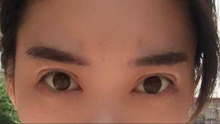 韓式開(kāi)眼角的有副作用嗎？