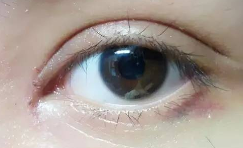 韓式開眼角術后怎么護理？