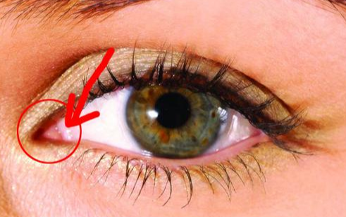 開內(nèi)眼角手術(shù)有什么效果？術(shù)后有哪些注意事項？