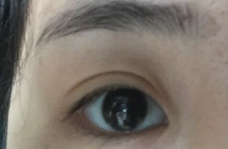 開內(nèi)眼角拆線后變化明顯嗎？開內(nèi)眼角會不會留疤？