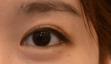 開(kāi)個(gè)外眼角手術(shù)有多大風(fēng)險(xiǎn)？