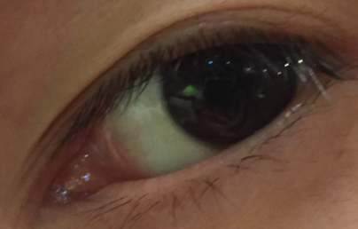 開眼角大概多少錢？開外眼角效果好不好？