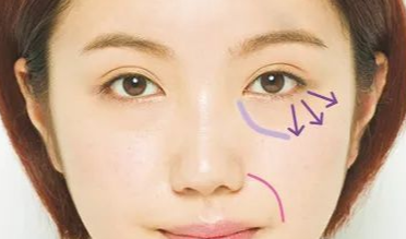 開內(nèi)外眼角的效果如何？