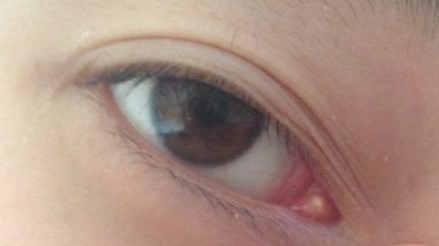 開內(nèi)外眼角的方法有哪些？