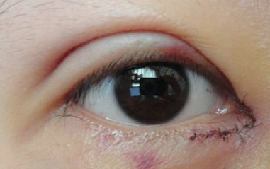 開內(nèi)眼角過程中會疼嗎？開內(nèi)眼角的風(fēng)險有哪些？