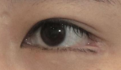 開內(nèi)眼角都會回縮嗎？
