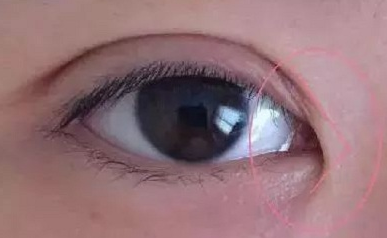 開內(nèi)眼角的作用有哪些？