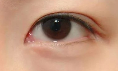 開內(nèi)眼角的優(yōu)缺點(diǎn)有哪些？