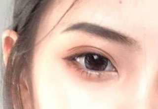 開(kāi)內(nèi)外眼角有什么壞處？