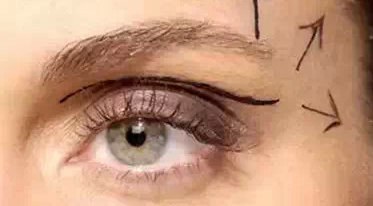 開內(nèi)外眼角需要幾次？