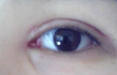 開內(nèi)外眼角效果怎么樣？