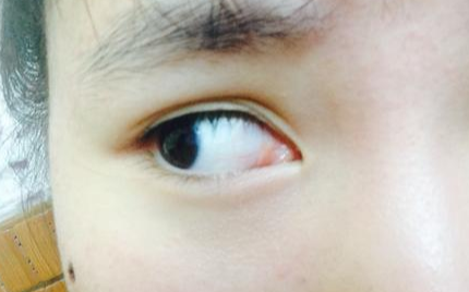 開(kāi)內(nèi)眼角風(fēng)險(xiǎn)有多大？