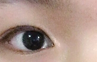 開內眼角的危害有哪些？