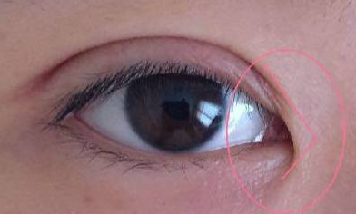 開內(nèi)眼角多久才能恢復(fù)自然？