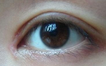開內(nèi)眼角的禁忌癥是什么？