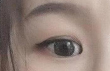 開內(nèi)眼角的手術(shù)費(fèi)用多少？