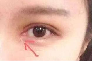 開眼角割雙眼皮拆線嗎？術(shù)后拆線疼嗎？