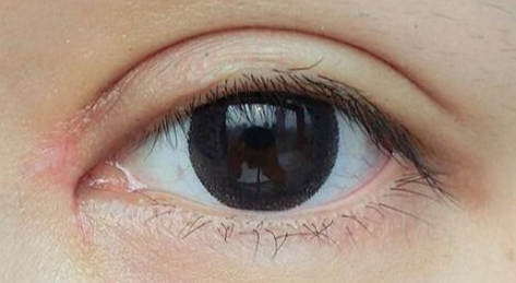 開眼角有哪些優(yōu)缺點(diǎn)？開眼角方法的過(guò)程有哪些？