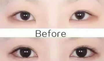 開眼角的危害大嗎？