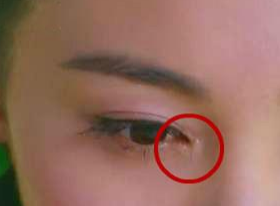 開眼角要增生多久？