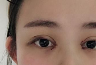 開眼角后多長(zhǎng)時(shí)間能恢復(fù)？