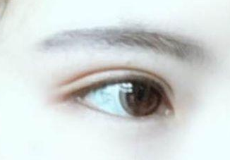 開眼角有幾種方法?開眼角有后遺癥嗎？