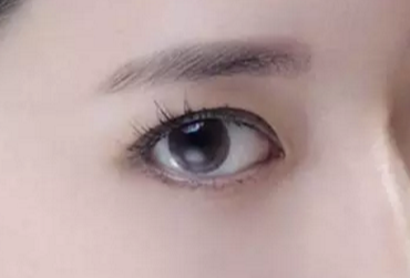 開眼角術(shù)后會(huì)不會(huì)反彈？