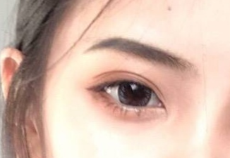 開眼角手術怎么樣？