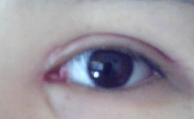 開(kāi)眼角手術(shù)有沒(méi)有風(fēng)險(xiǎn)？開(kāi)眼角手術(shù)有副作用嗎？