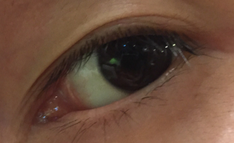 開眼角需要熱敷幾天？