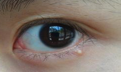 開外眼角手術(shù)會有后遺癥嗎？