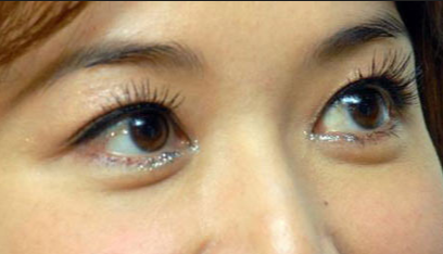 開眼角手術(shù)的優(yōu)點(diǎn)有哪些？開眼角手術(shù)有哪些安全性？